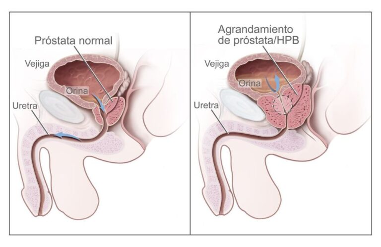 tratamiento para prostata